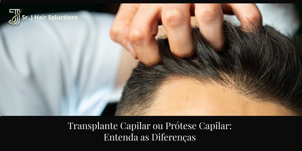 Transplante Capilar ou Prótese Capilar: Entenda as Diferenças