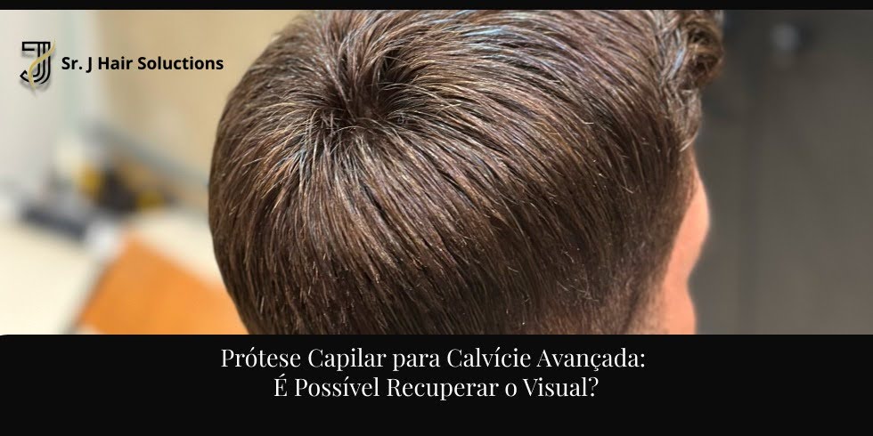 Prótese Capilar para Calvície Avançada: É Possível Recuperar o Visual?
